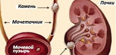 Диету 14 прописывают при мочекаменной болезни